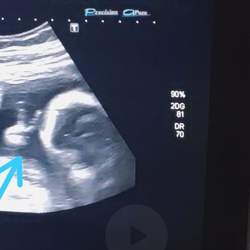 Bebê faz 'V de vitória' durante ultrassom e pai com câncer raro vê sinal divino