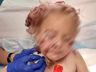 Criança de 5 anos é brutalmente atacada por cachorro e leva 50 pontos no rosto