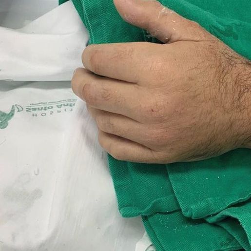 Homem tem mão reimplantada após colocá-la em gelo em Santa Catarina