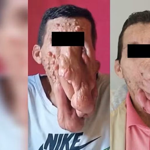 Cirurgia retira 700g de tumores do rosto de homem com doença rara em SC