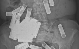 Mulher com 55 pilhas dentro do corpo deixa médicos chocados: 'Maior quantidade engolida'