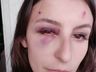 VÍDEO: maquiadora usa redes sociais para denunciar agressões do namorado em SMO