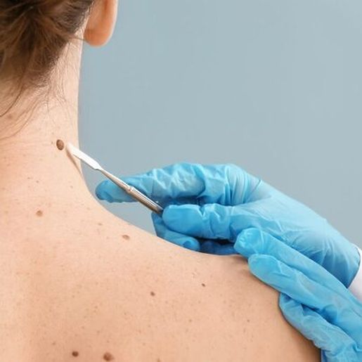 SC é o estado que mais registra casos de melanoma no Brasil