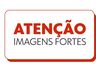 Cirurgia retira 700g de tumores do rosto de homem com doença rara em SC
