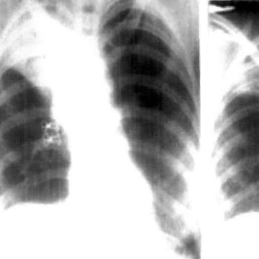 Mulher com sintomas de tuberculose tinha camisinha no pulmão