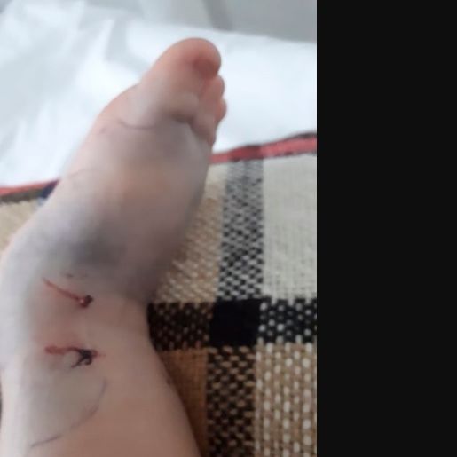 Menino picado por Jararaca no Paraná recebe alta hospitalar