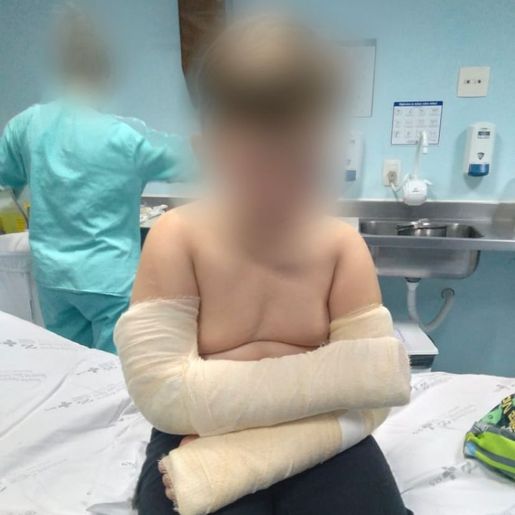 Criança cai de Balanço em escola e sofre fraturas nos braços em Paraíso, mãe acusa negligência