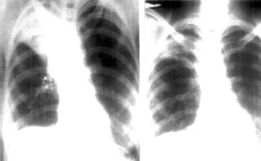Mulher com sintomas de tuberculose tinha camisinha no pulmão