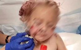 Criança de 5 anos é brutalmente atacada por cachorro e leva 50 pontos no rosto