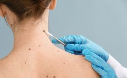 SC é o estado que mais registra casos de melanoma no Brasil