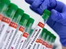 Anvisa aprova registro de 1º teste para varíola dos macacos