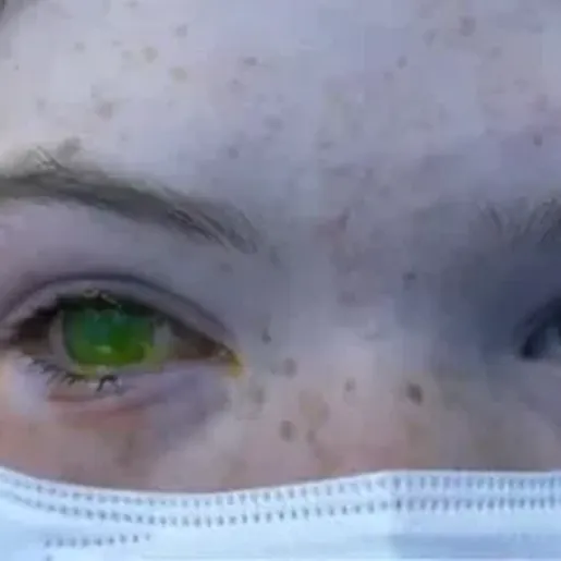 Doença deixa olho esverdeado e provoca dor intensa em pacientes na Austrália