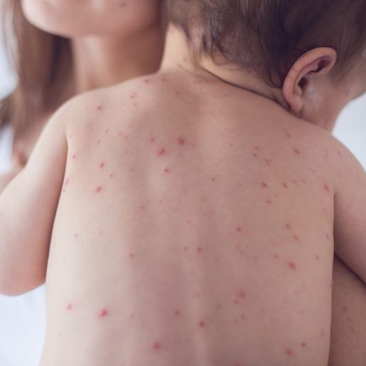 Extremo Oeste recebe reforço na vacinação com Dose Zero contra o sarampo para bebês