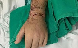 Homem tem mão reimplantada após colocá-la em gelo em Santa Catarina