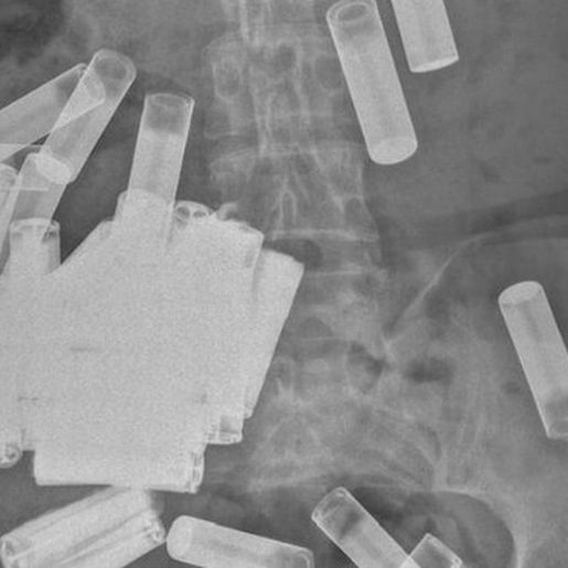 Mulher com 55 pilhas dentro do corpo deixa médicos chocados: 'Maior quantidade engolida'