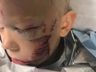 Menino salva a irmã de ataque de cachorro e fica com rosto desfigurado