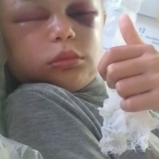 Criança se recupera no hospital após ser picada por cobra Urutu