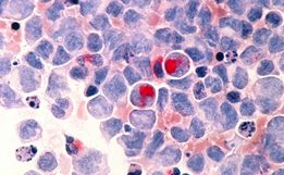 OMS estima 35,3 milhões de novos casos de câncer em 2050