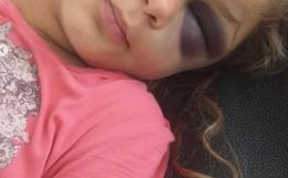 Criança se recupera no hospital após ser picada por cobra Urutu