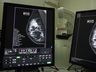 SC realiza mutirão de mamografias com prioridade para pacientes na fila de espera