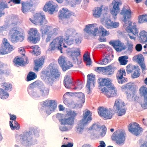 OMS estima 35,3 milhões de novos casos de câncer em 2050