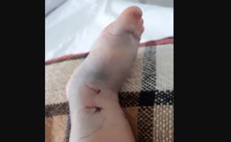 Menino picado por Jararaca no Paraná recebe alta hospitalar